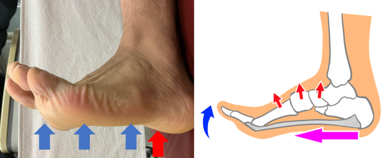足底腱膜炎についてのアイキャッチ画像