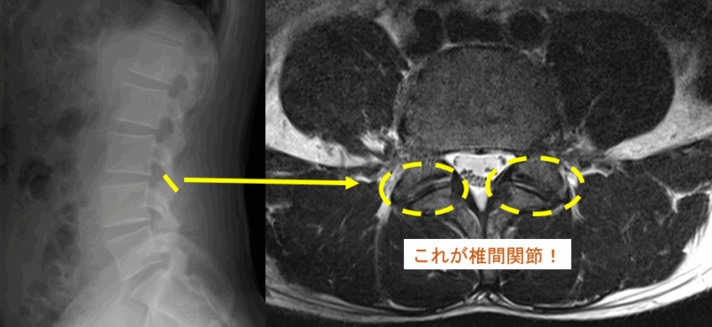 椎間関節性の疼痛に関して知識を深めて適切に対処しましょう!!のアイキャッチ画像